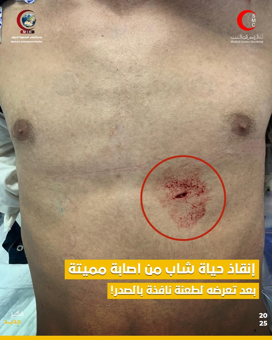 فريق طبي بمستشفى المنصورة الدولي ينقذ شابًا من موت محقق بعد طعنة مباشرة في القلب