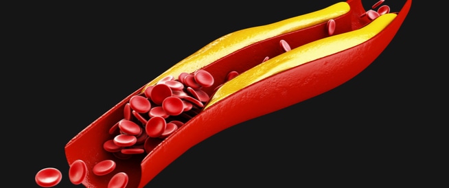 أعراض ارتفاع الكوليسترول الضار في الدم