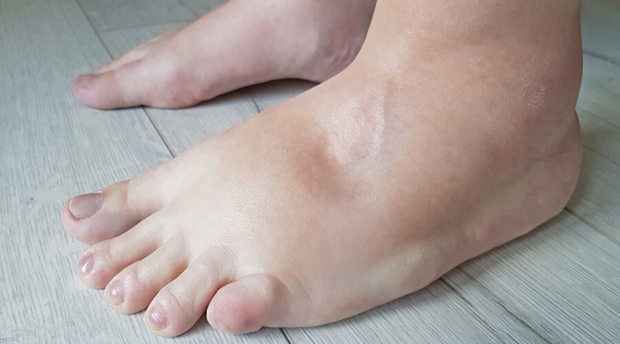 أسباب تورم الرجلين