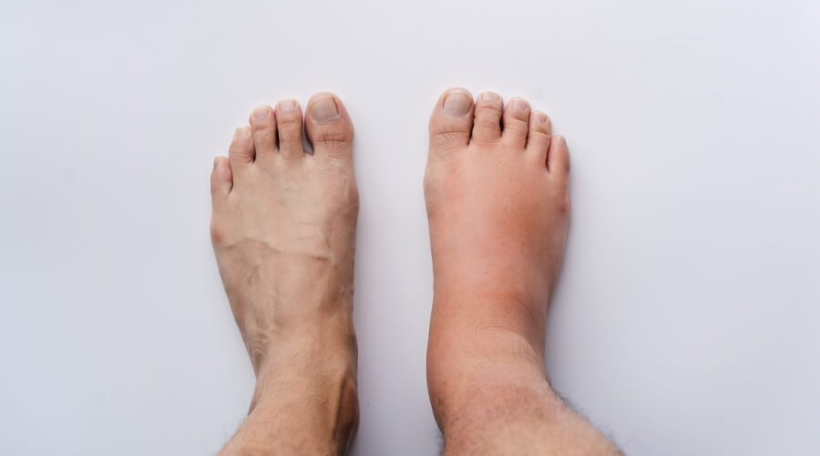 أسباب تورم الرجلين