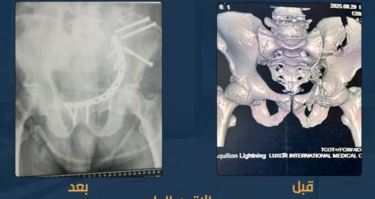 العملية قبل وبعد 