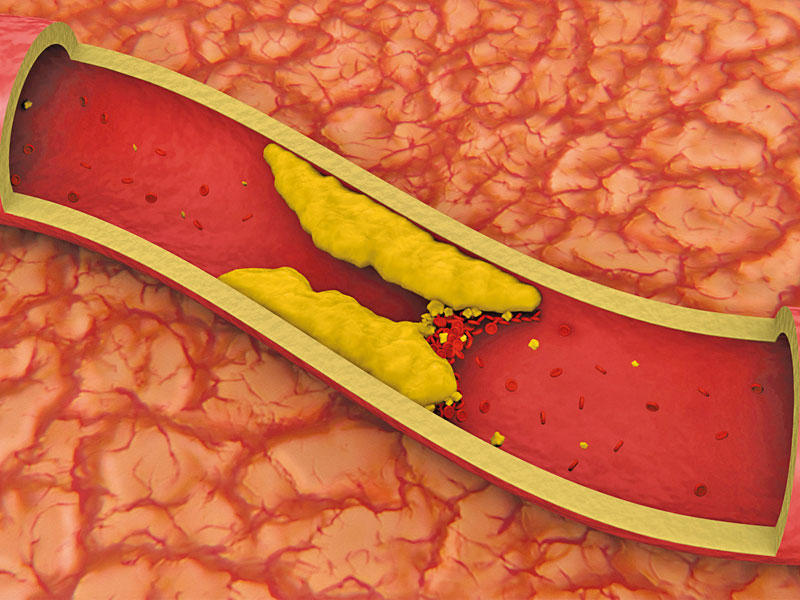 أهم علامات انسداد الشرايين في الساقين