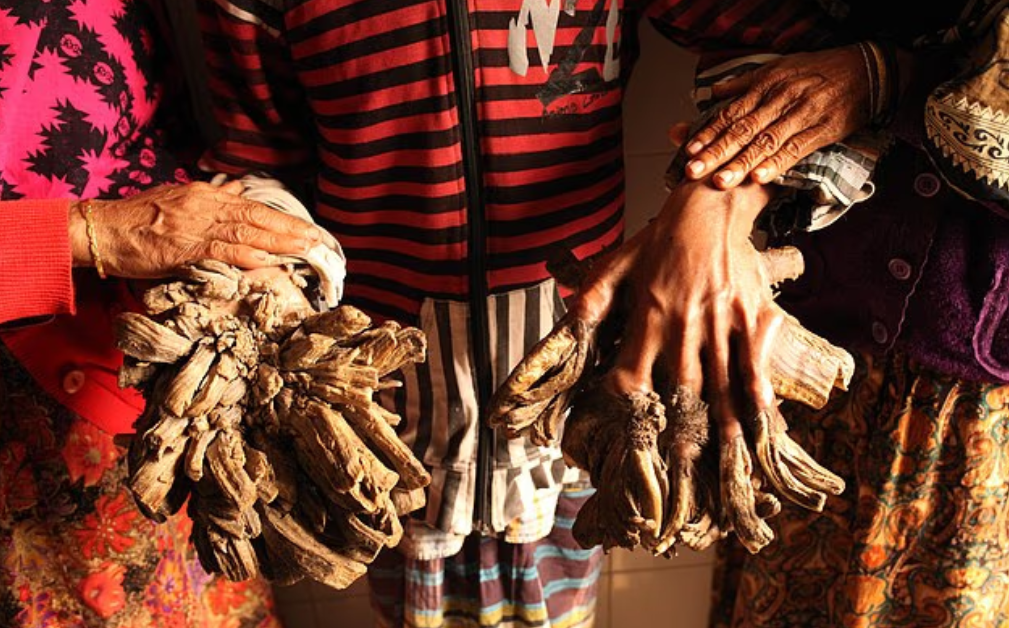 متلازمة الرجل الشجرة