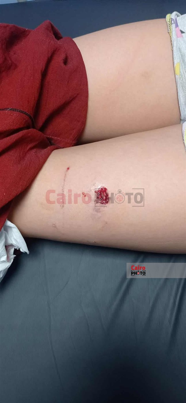 طالب مصاب بـ عقر الكلب 