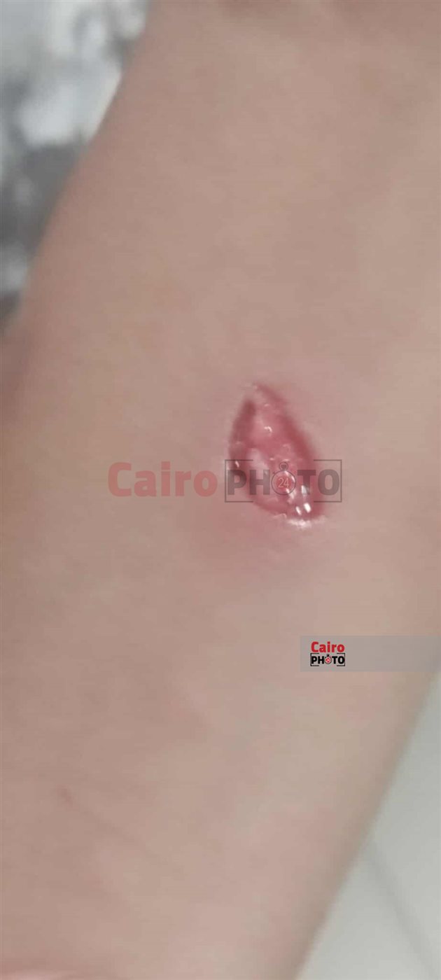 طالب مصاب بـ عقر الكلب 