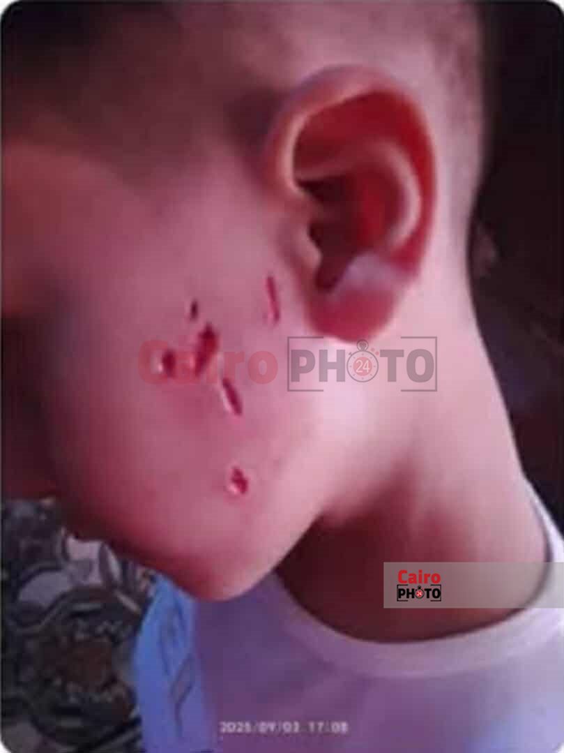 طالب مصاب بـ عقر الكلب 