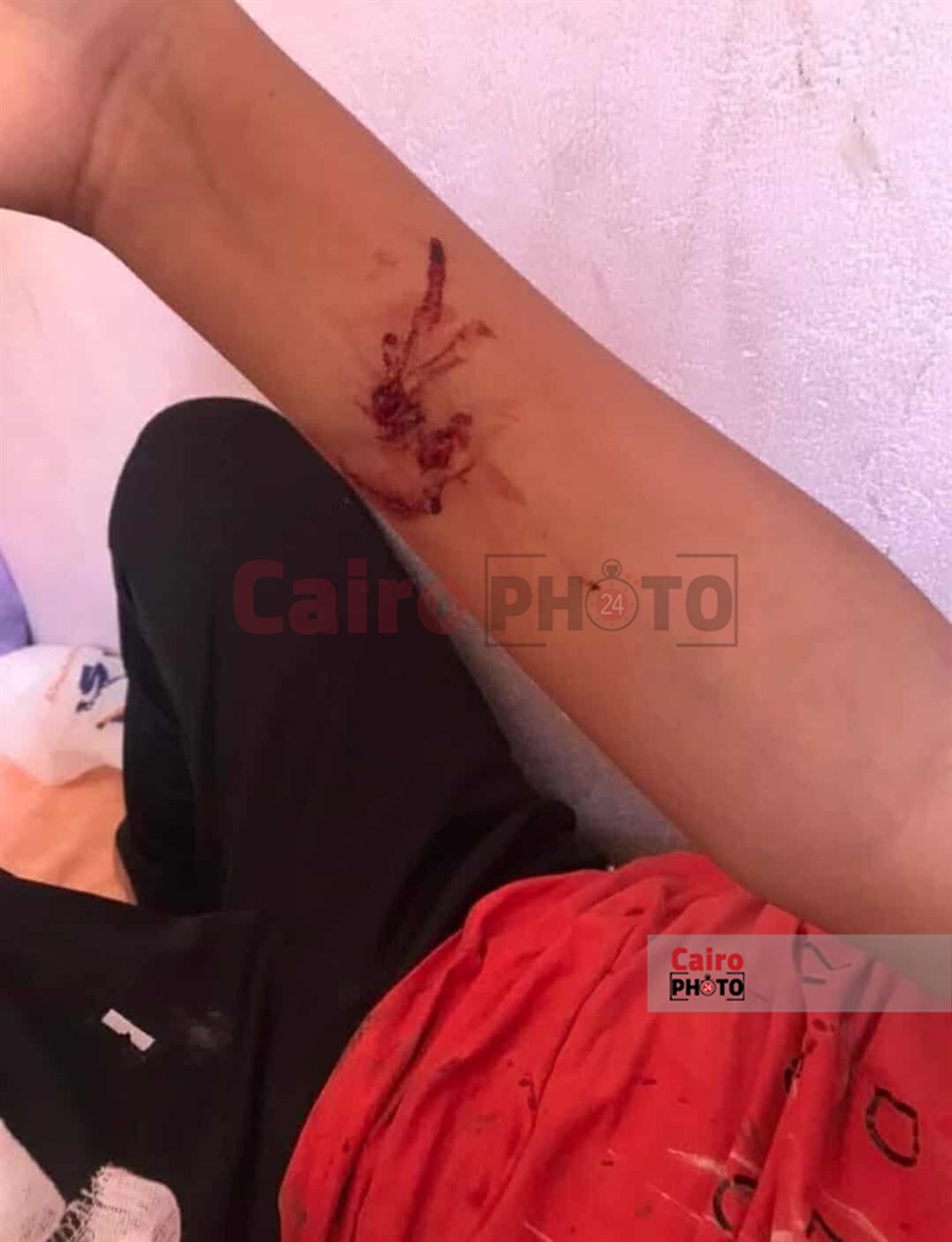 طالب مصاب بـ عقر الكلب 