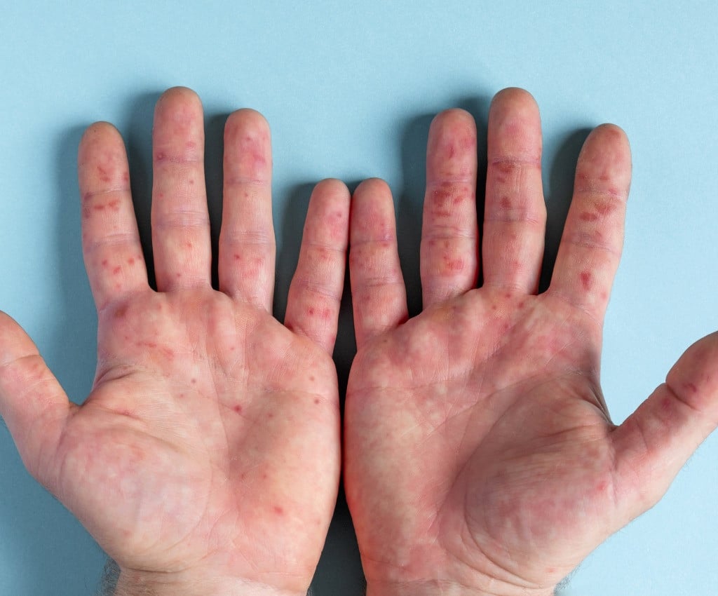 متى تنتهي عدوى فيروس الفم واليد والقدم