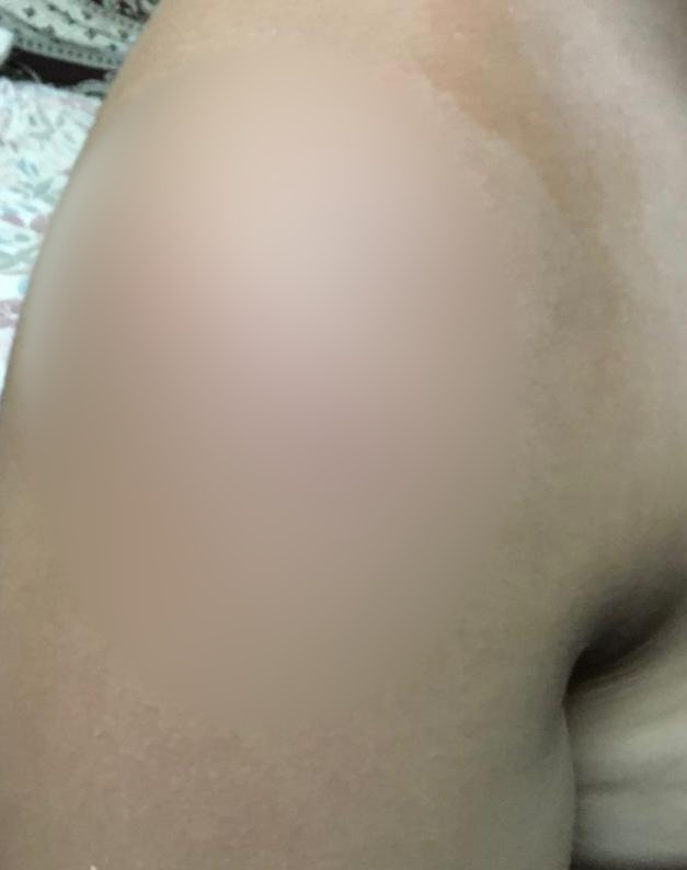 كدمات متفرقة بجسد الطالب