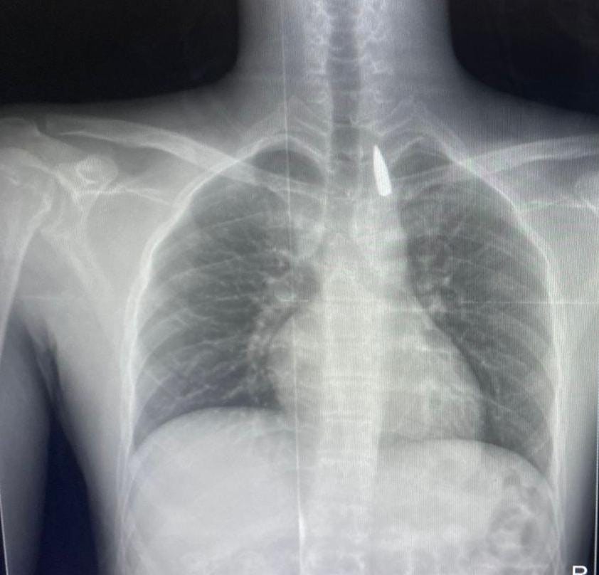 أشعة مكان الرصاصة 