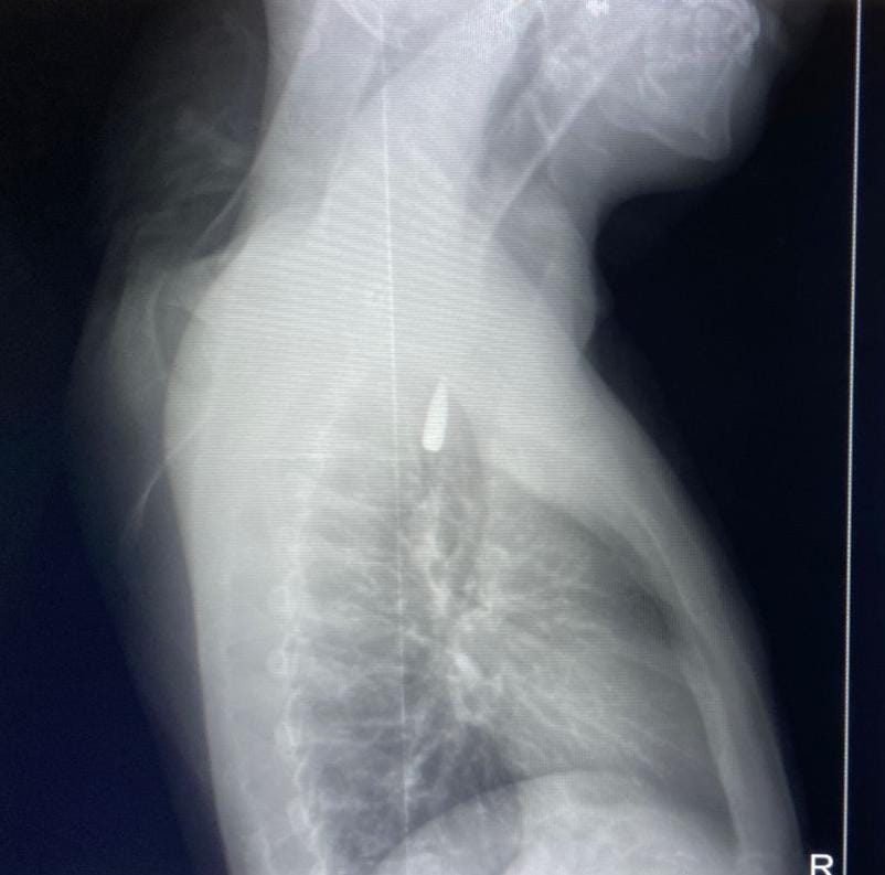 أشعة مكان الرصاصة 