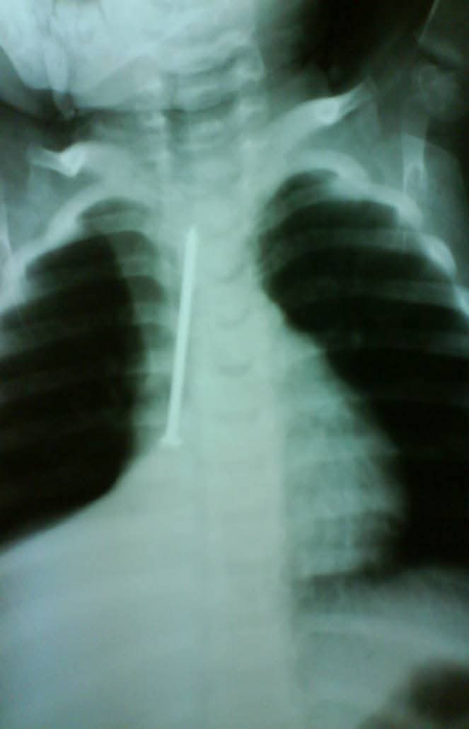 إنقاذ طفلة ابتلعت مسمارًا بمستشفى الأطفال التخصصي ببنها