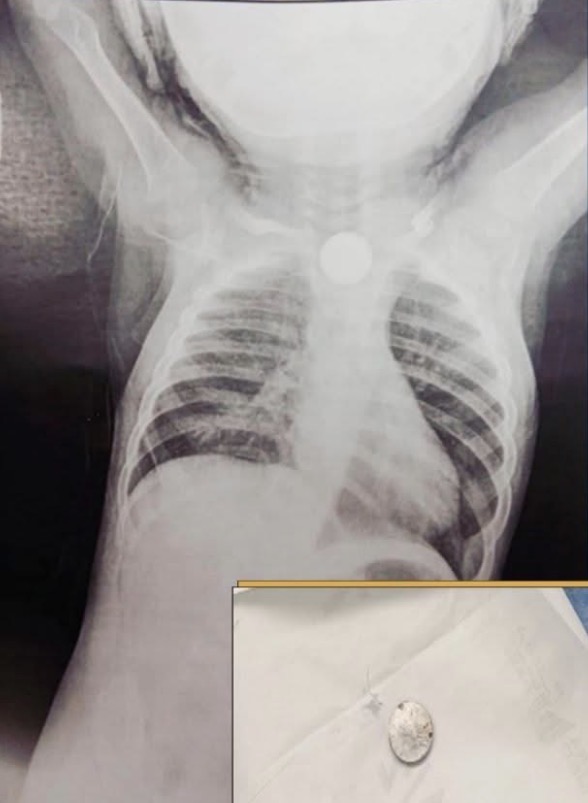 اشعة الطفل والبطارية المستخرجة 