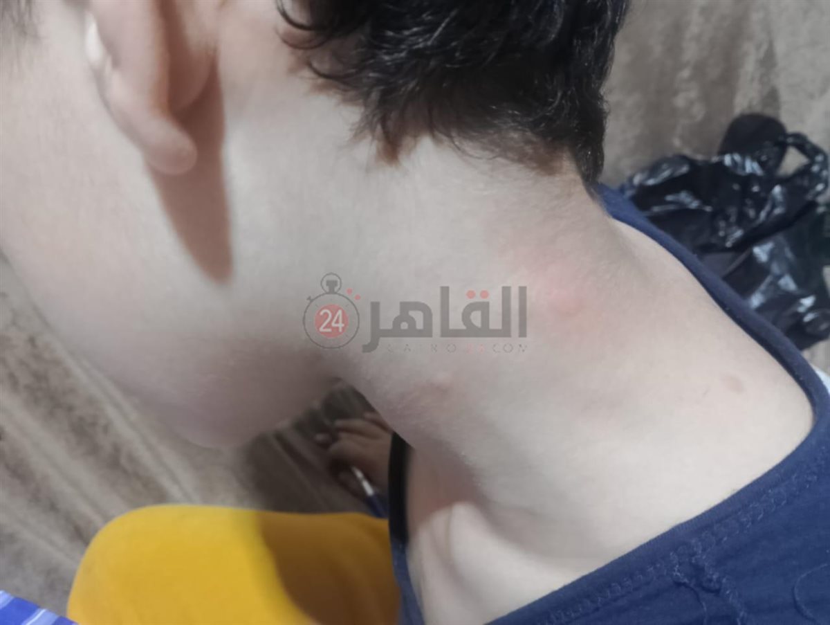  أولياء أمور مدرسة بالقاهرة يستغيثون من انتشار حشرات البق داخل الفصول 