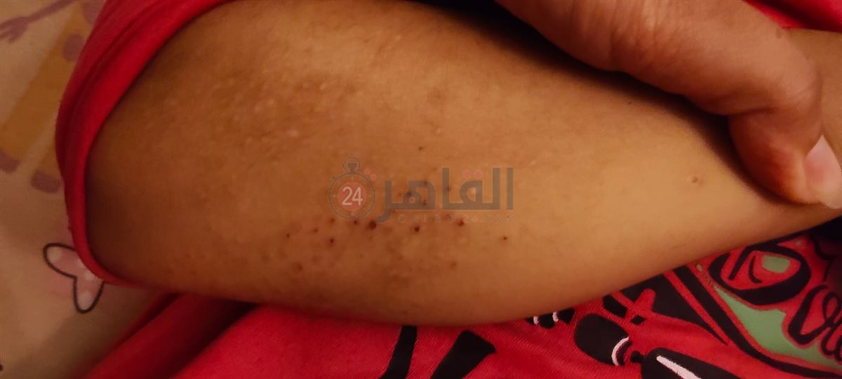  أولياء أمور مدرسة بالقاهرة يستغيثون من انتشار حشرات البق داخل الفصول 