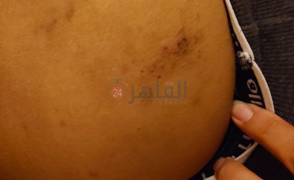  أولياء أمور مدرسة بالقاهرة يستغيثون من انتشار حشرات البق داخل الفصول 