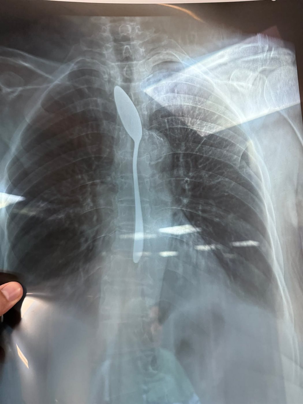 سيدة تبتلع معلقة شاي بالمنوفية 