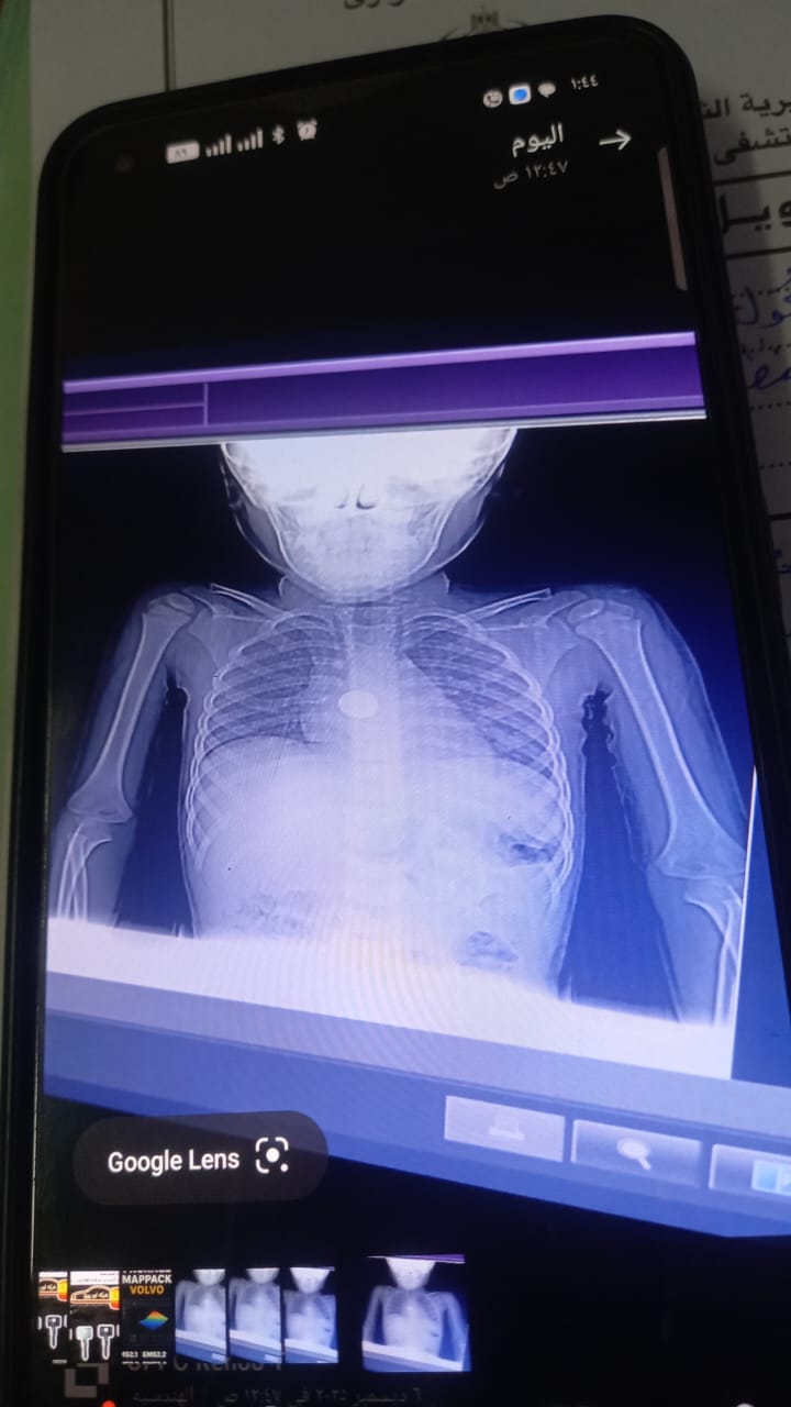 استخراج بطارية ابتلعها طفل بعمر 5 سنوات