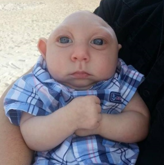 متلازمة الطفل الضفدع