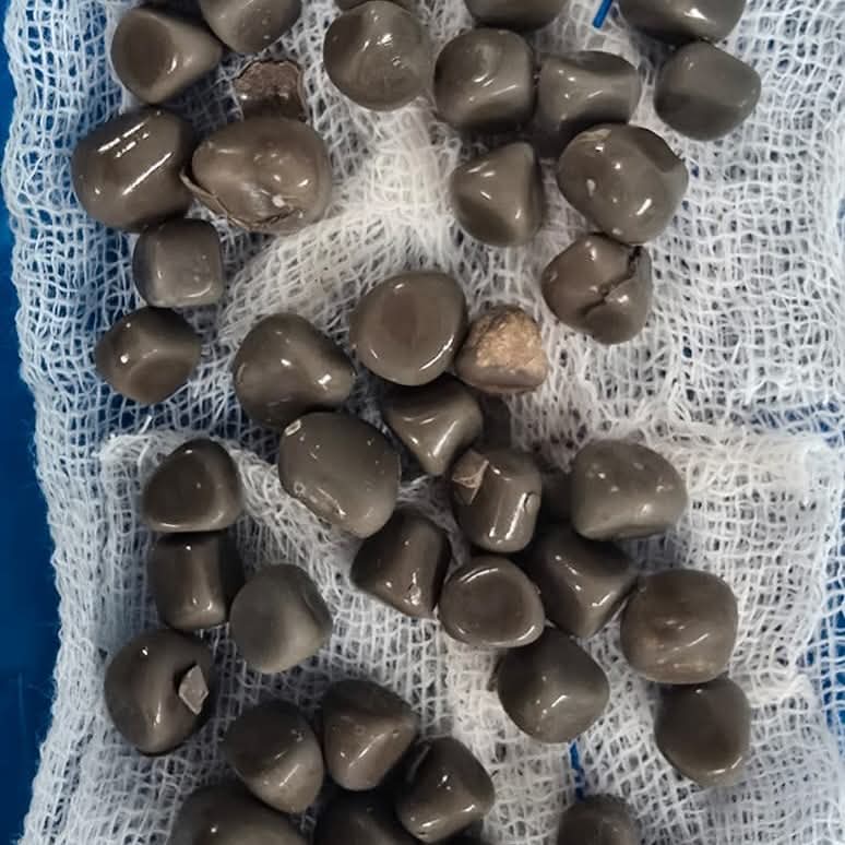 استخراج 58 حصوة من كلية مريض