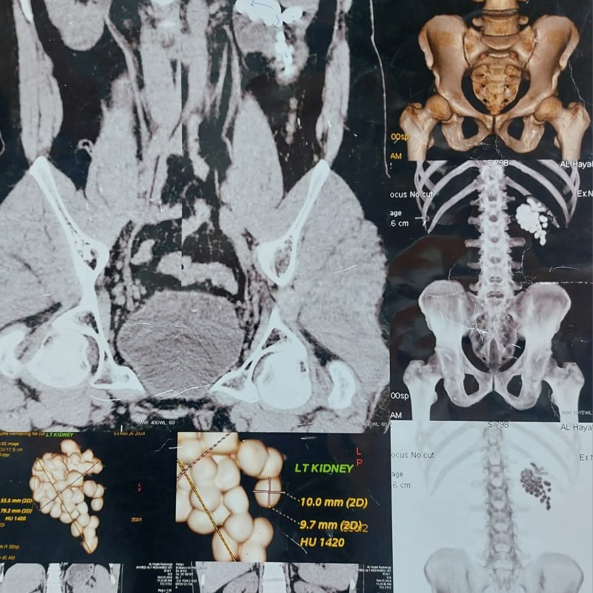 استخراج 58 حصوة من كلية مريض