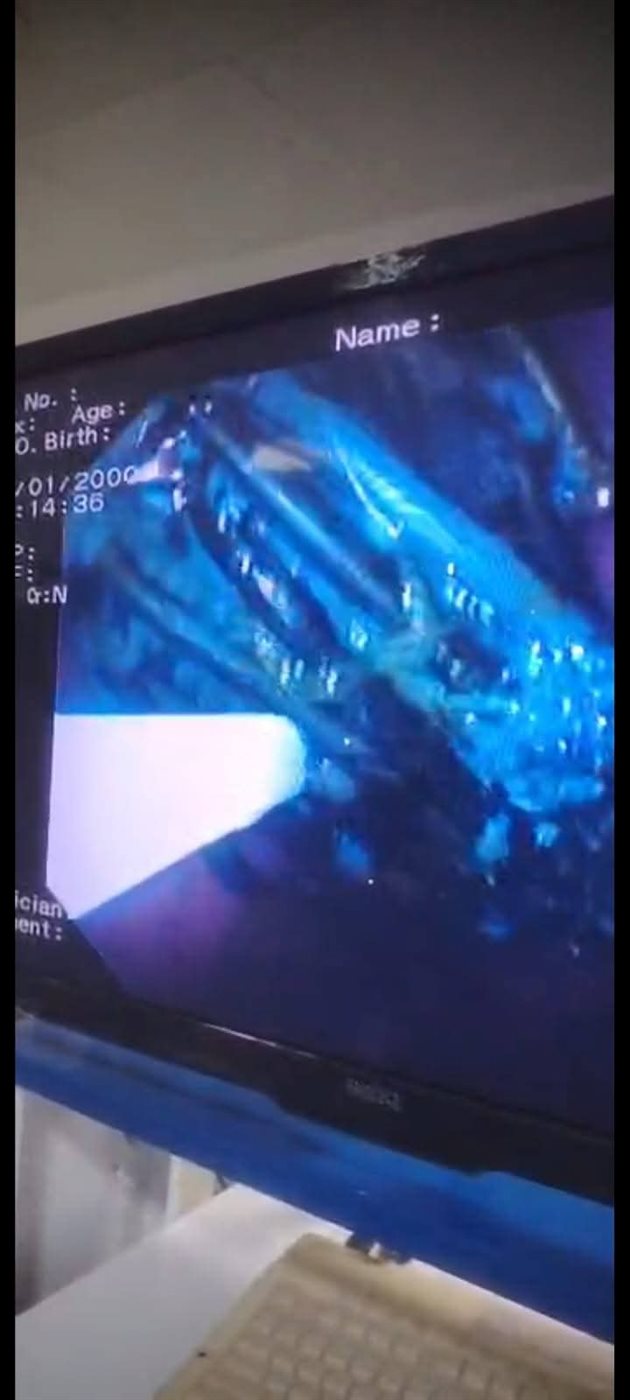 مستشفي كفر الشيخ العام تنجح في إستخراج 34 مسمار&nbsp;