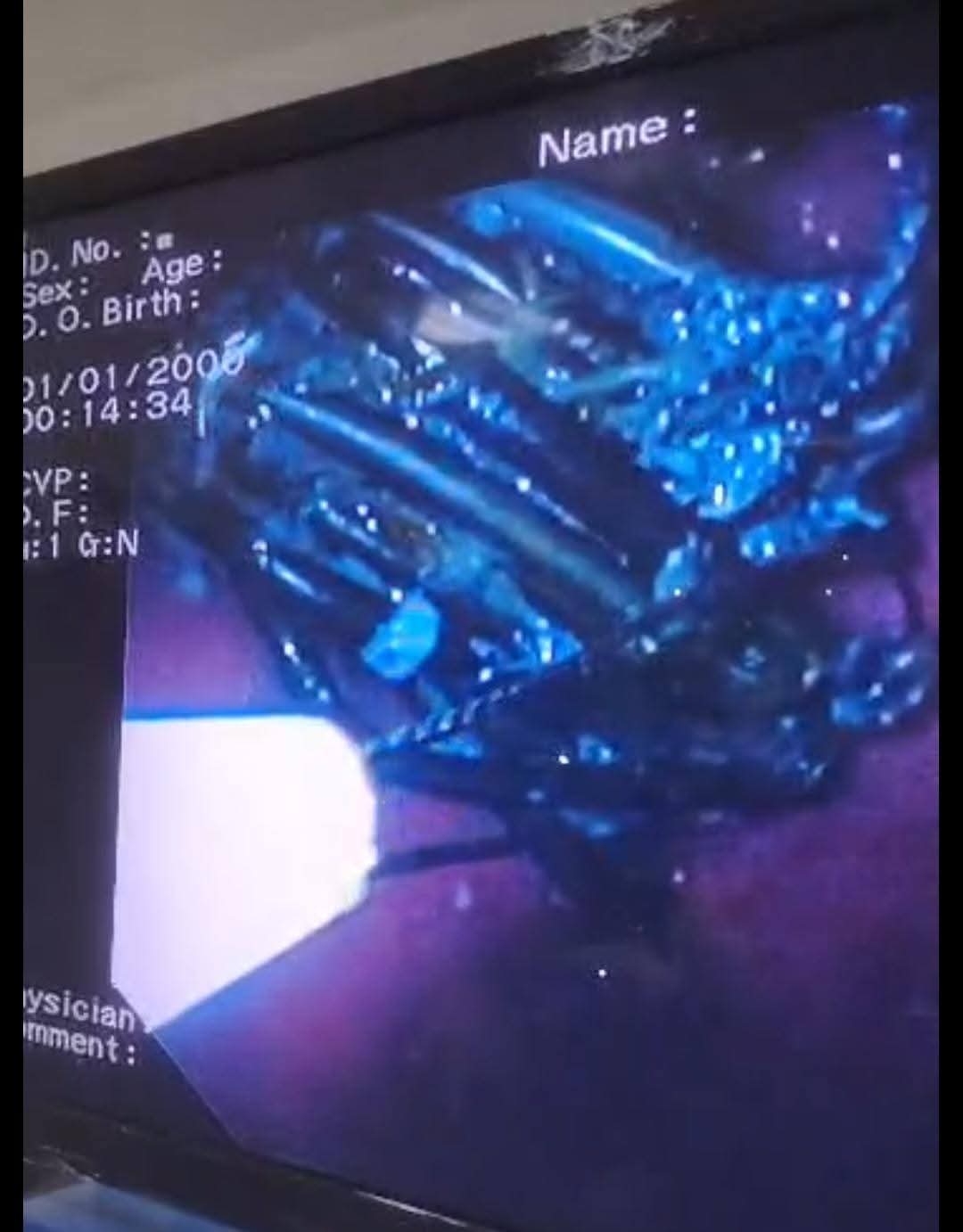 مستشفي كفر الشيخ العام تنجح في إستخراج 34 مسمار&nbsp;