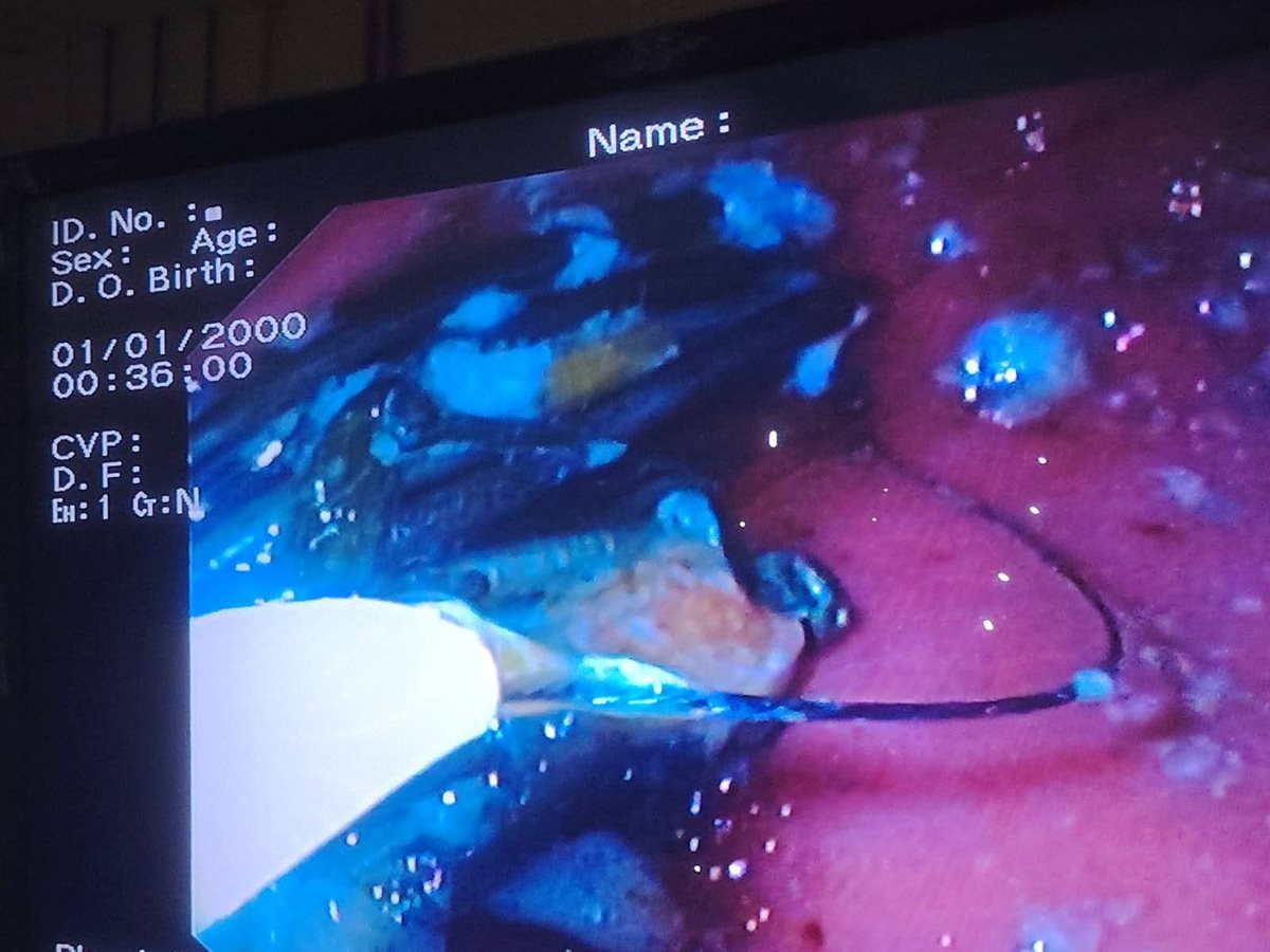 مستشفي كفر الشيخ العام تنجح في إستخراج 34 مسمار&nbsp;