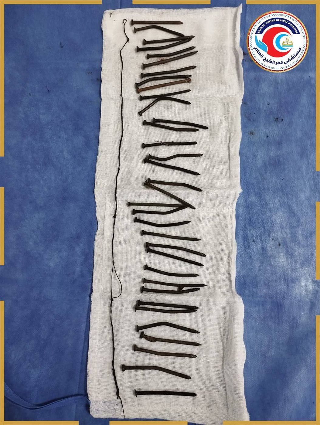 مستشفي كفر الشيخ العام تنجح في إستخراج 34 مسمار&nbsp;