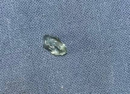 مستشفى الأزهر بأسيوط تعيد الرؤية لمريضة بعد استخراج جسم زجاجي مستقر بالجيب الأنفي أسفل العين منذ 10 سنوات