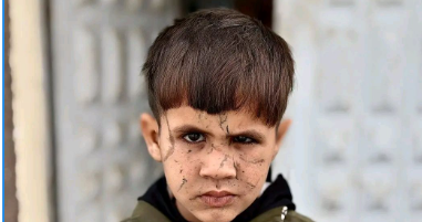 &nbsp;قصة طفل فسطيني فقد عينه اليسرى وأصيب بتشوهات مؤلمة بسبب القصف الإسرائيلي