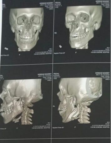 مستشفى الفيوم العام يجري جراحة دقيقة في الوجه والفكين لإنقاذ شاب مصاب بحادث سير