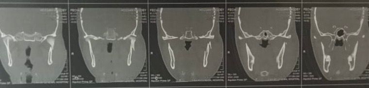 مستشفى الفيوم العام يجري جراحة دقيقة في الوجه والفكين لإنقاذ شاب مصاب بحادث سير