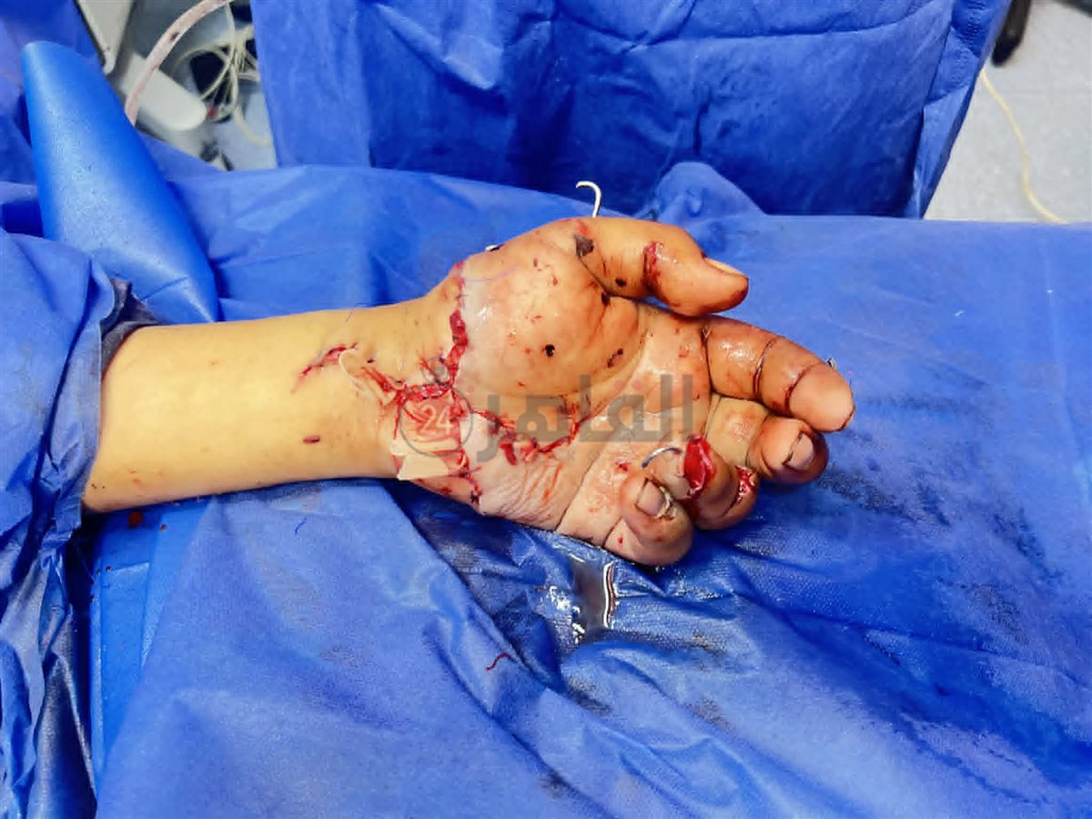 استغرقت 16 ساعة.. فريق طبي أزهري بمستشفى سيد جلال ينجح في إعادة يد شاب عمره 37 بعد بترها بالكامل