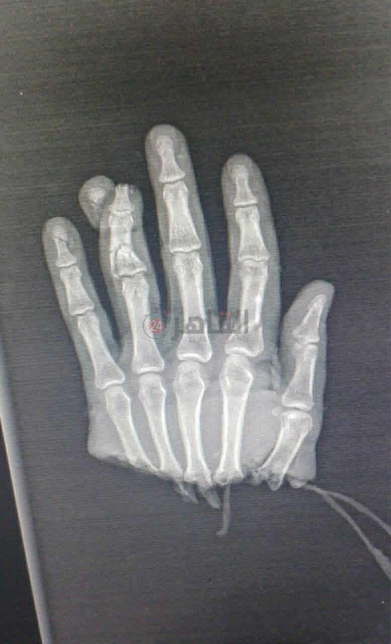 استغرقت 16 ساعة.. فريق طبي أزهري بمستشفى سيد جلال ينجح في إعادة يد شاب عمره 37 بعد بترها بالكامل