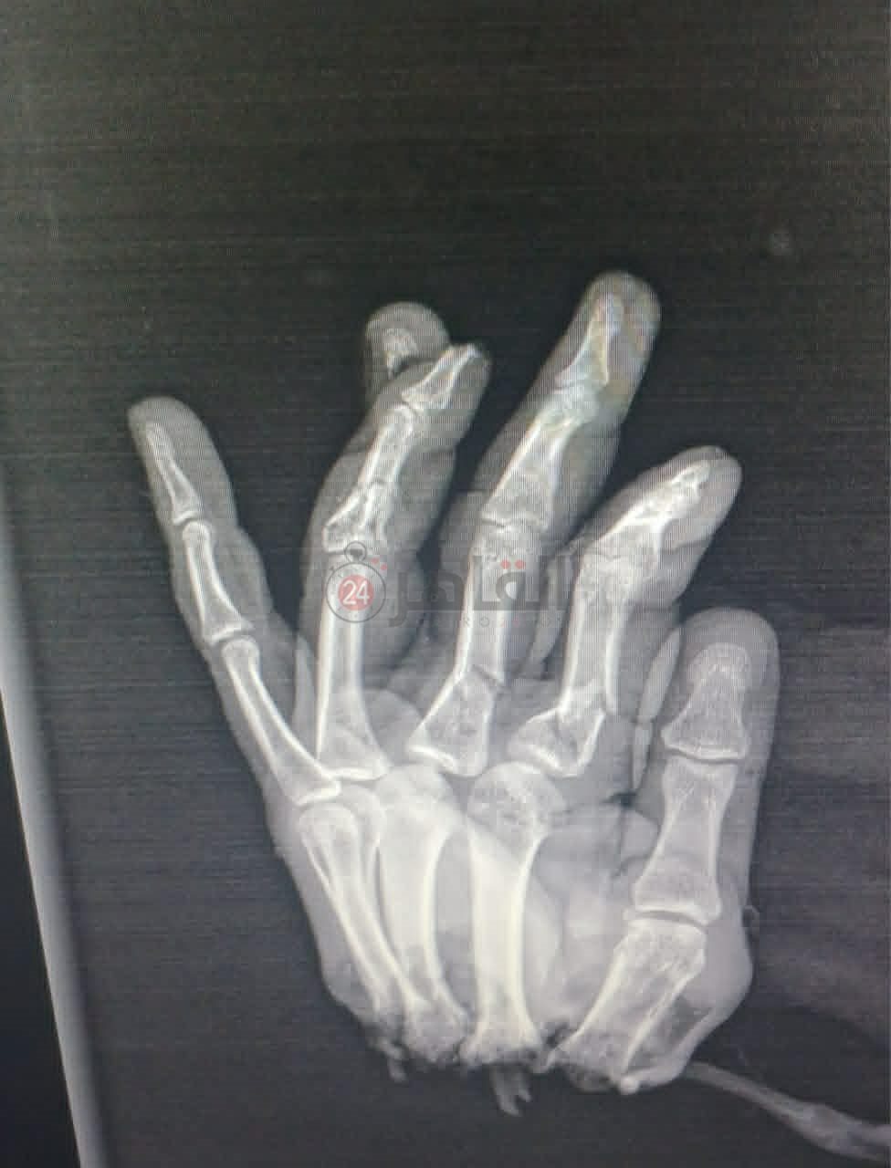 استغرقت 16 ساعة.. فريق طبي أزهري بمستشفى سيد جلال ينجح في إعادة يد شاب عمره 37 بعد بترها بالكامل