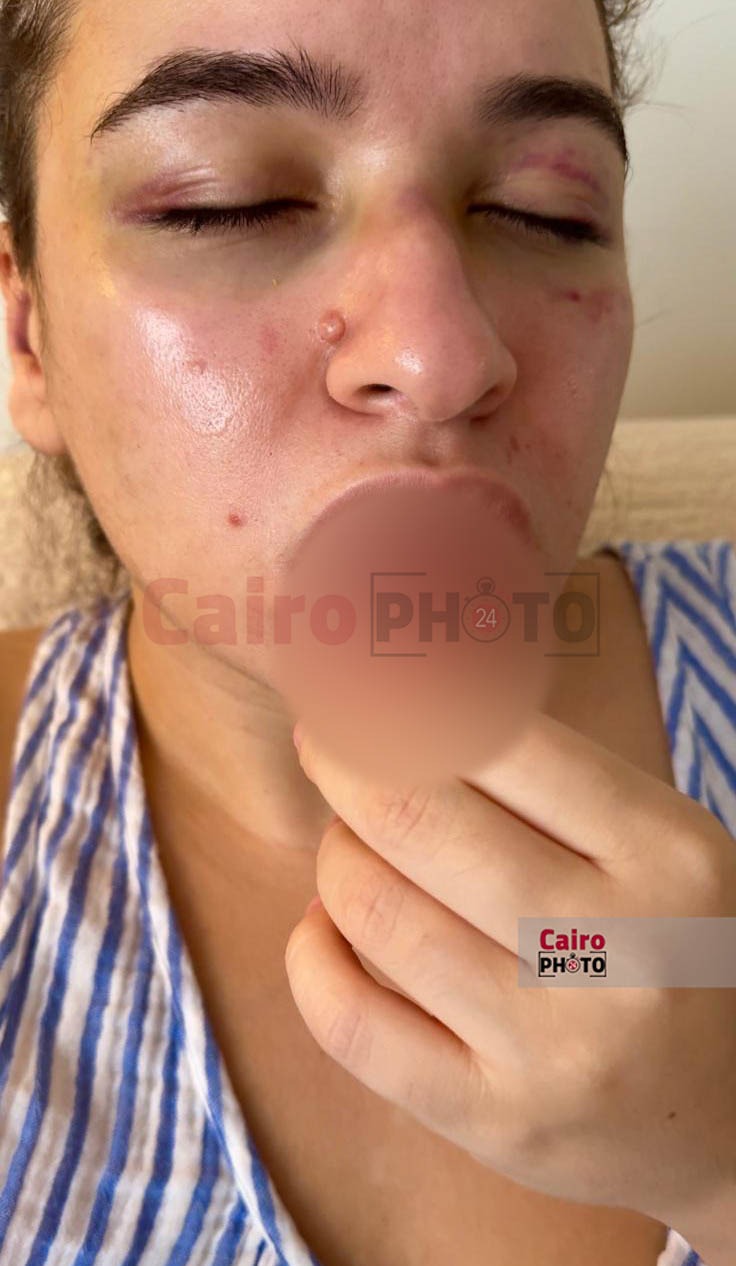 زوجة الفنان محمود حجازي بعد تعديه عليها بالضرب