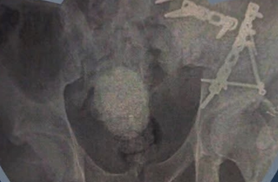 نجاح جراحة عظام معقدة بالمجمع الطبي الدولي