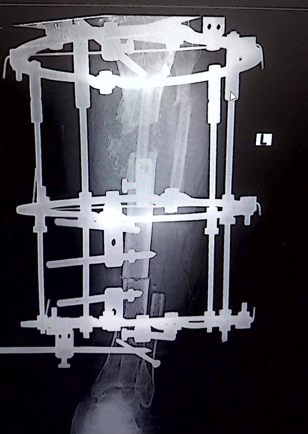 نجاح جراحة زراعة عظام لمسنة بالأقصر