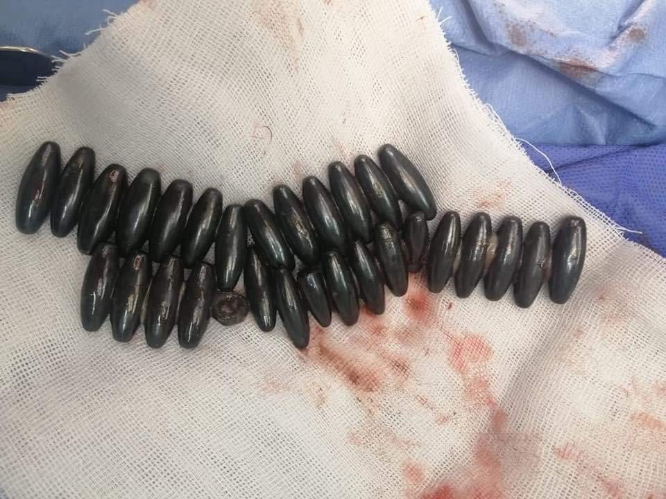 القطع المعدنية بعد استخراجها من بطن الطفلة