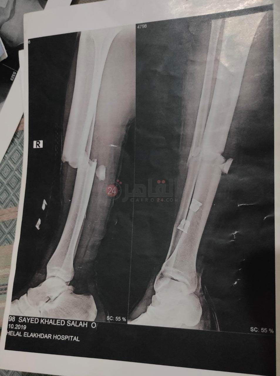 آشعة على ساق اللاعب فور الإصابة 02