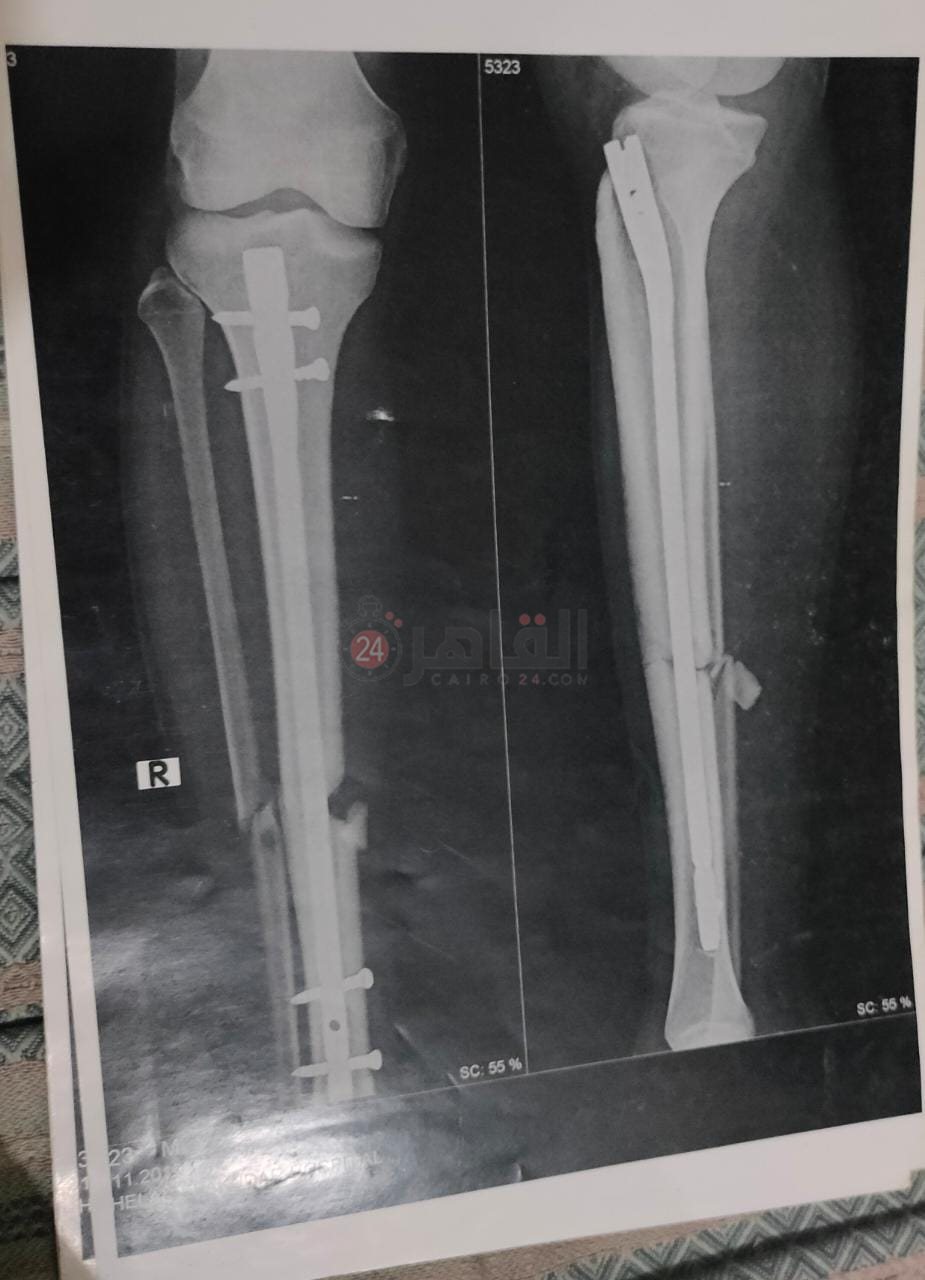 آشعة على ساق اللاعب فور الإصابة