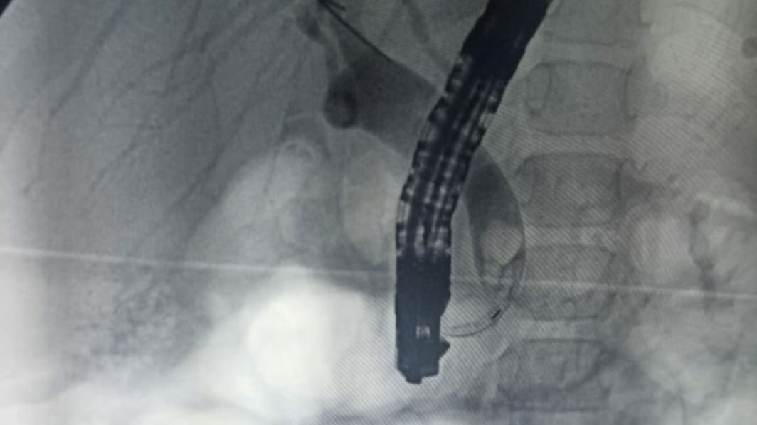 العلاج بالليزر أو الأشعة