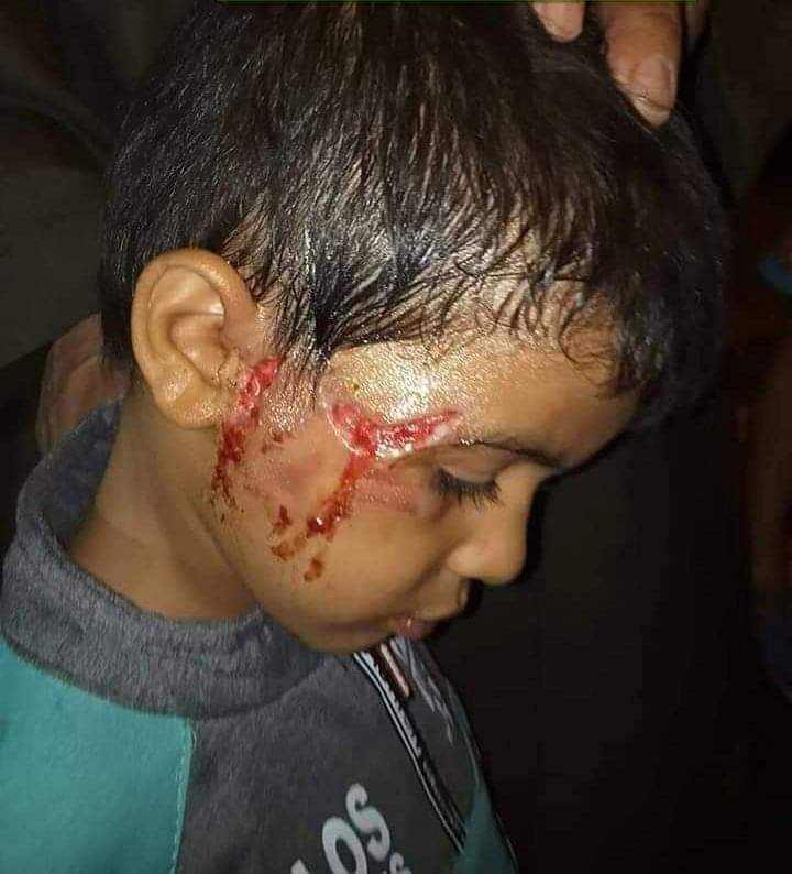 الأطفال المصابين بعقر كلب مسعور في الفيوم