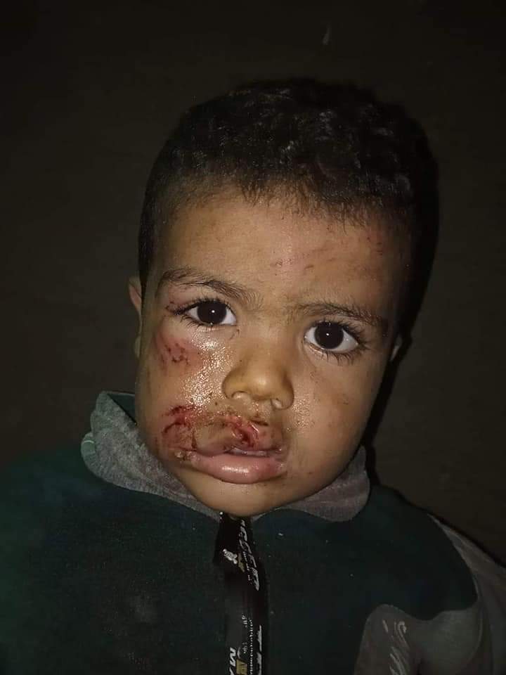 الأطفال المصابين بعقر كلب مسعور في الفيوم