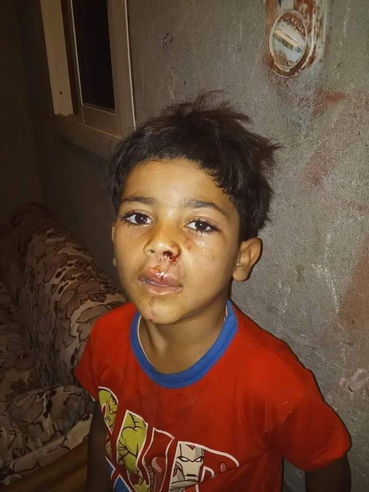 الأطفال المصابين بعقر كلب مسعور في الفيوم