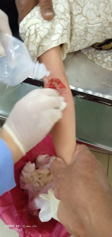 كلب مسعور يهاجم طفلة في الفيوم