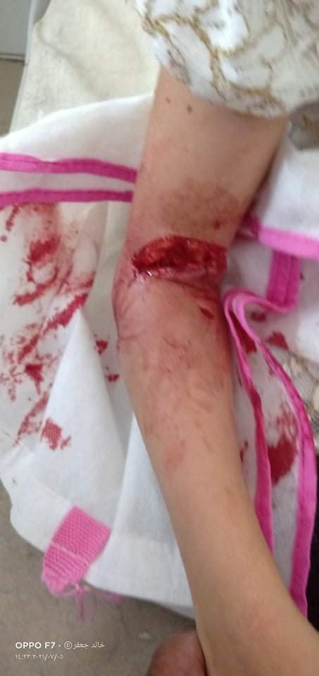 كلب مسعور يهاجم طفلة في الفيوم