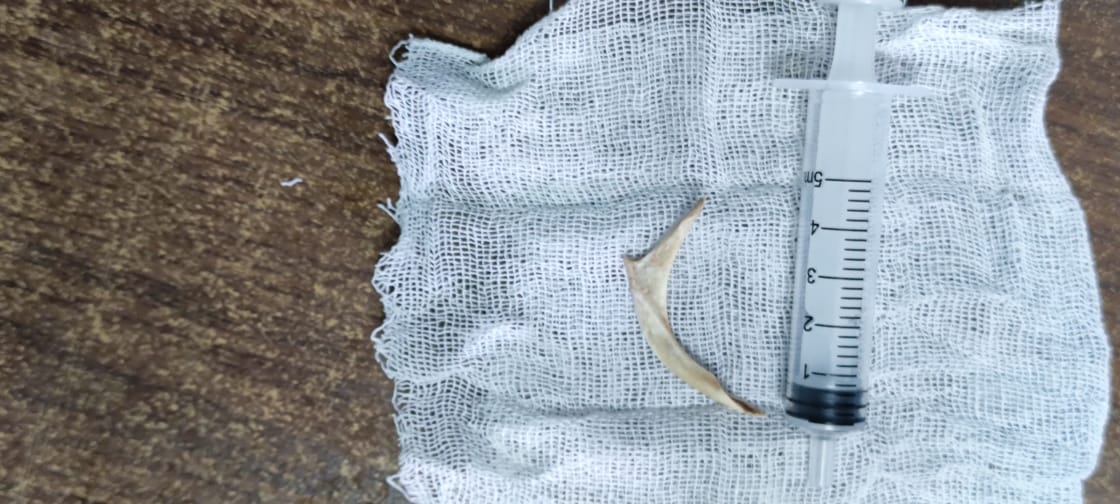 استخراج جسم غريب من مريء مريض بأسوان 