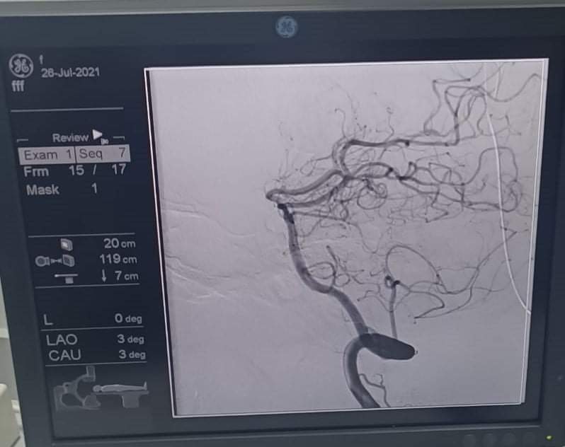 إجراء أول قسطرة مُخية لحالتين في الفيوم